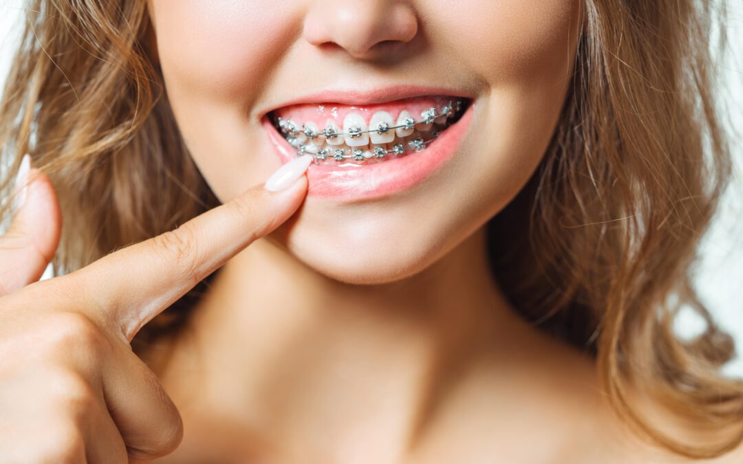 Tipps für das Vorbeugen von Karies bei festen Zahnspangen
